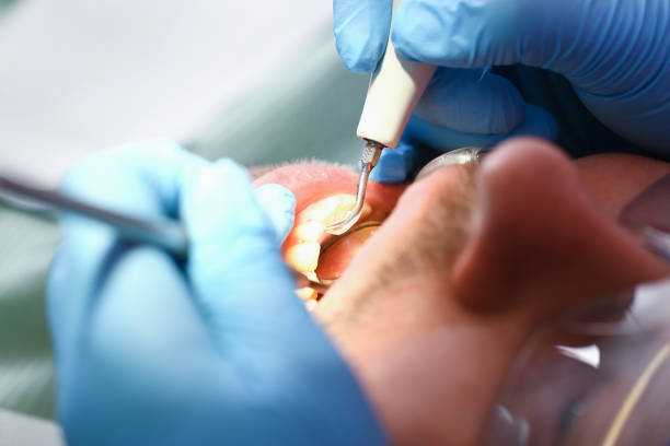 Best Emergency Root Canal Treatment in Laguna Hills, CA